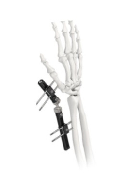 Orthopedic Wrist External Fixator Standard Single sided Integrated