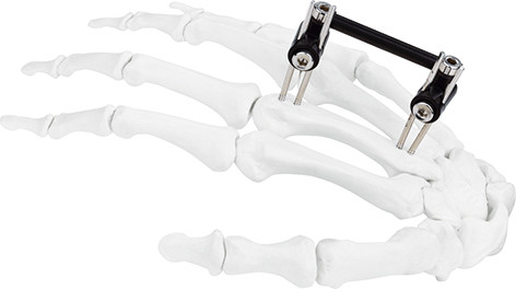 Hand Bone Pin Stent Radius Mini External Fixator Ortho Combined Type