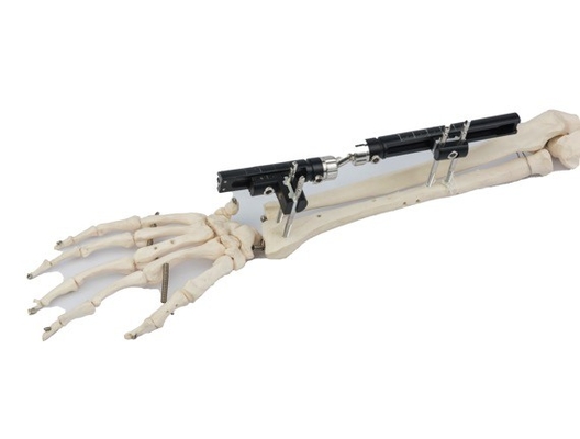 Sterilized Bone Fracture Distal Radius External Fixator